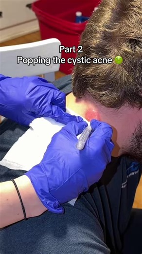Cystic Acne Popping Experience with Friends