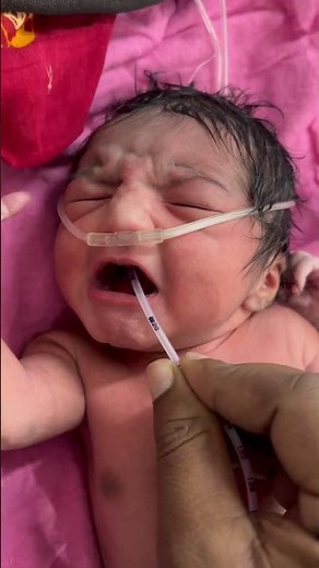 How an NG Tube Is Inserted in a Newborn Baby #NewbornCare #NGTubeInsertion #NICUProcedure#InfantCare
