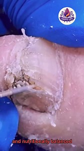 Effective Toenail Support for Toenail Swelling For All-Day Relief 🌸🍎 #WellnessSeniors #SimpleHealthTricks #HealthyHabits | Health - Wellness