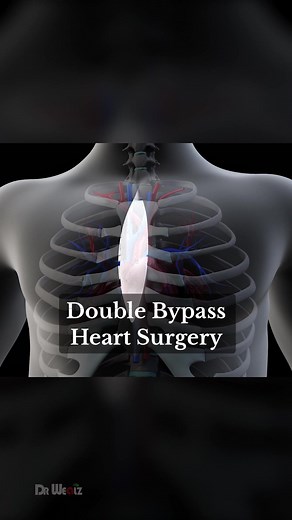 Double Bypass Heart Surgery #heart #surgery #health