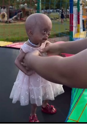 Elis slowly getting her voice back & the twins having so much fun!!! #eliseeloa #progeria #linda #twinsisters
