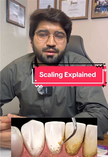 Scaling 🦷✨ Scaling is a professional dental procedure that removes plaque and tartar from teeth and below the gum line. It helps keep gums healthy, prevents bleeding, bad breath, and protects your smile from gum disease. ✔ Clean teeth ✔ Healthy gums ✔ Fresh breath Regular scaling = Long-lasting smile 😁. #alamdentalartistry #matta #dentist #oralhealtheducation #oralhealth