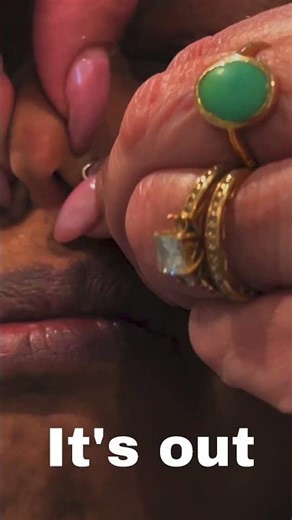 Part 2 : Safe removal of Nose Jewelry: Step-by-Step #piercingproblems #piercingcare #nosepiercing