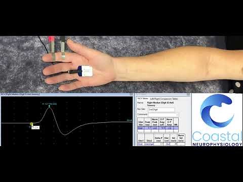 Sensory Nerve Conduction Study
