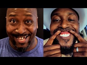 Long-term Review of All-on-4®: Don't get them before watching this