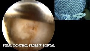 Re-Live Surgery: Arthroscopic Guided Latarjet with Screw Fixation: Updated Technique