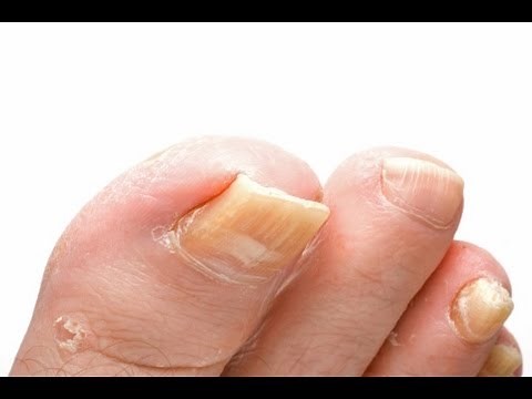 Toenail Fungus Treatment - How to Treat Toenail Fungus FAST With Home Treatments