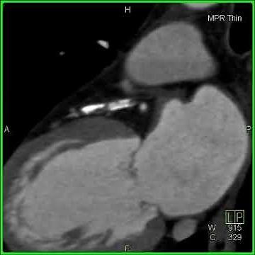 Cardiac: extensive calcifications in the LAD (3 of 4)