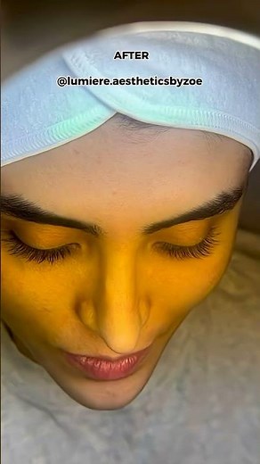 Microdermabrasion Before & After | Instant Glow & Smooth Skin