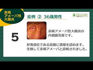 アメーバ性大腸炎