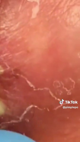 #pimpleexplosion #blackheadsremover #pimples #fyp #viral