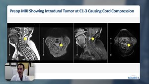 Intradural Spinal Tumor Resection With AMNIOFIX