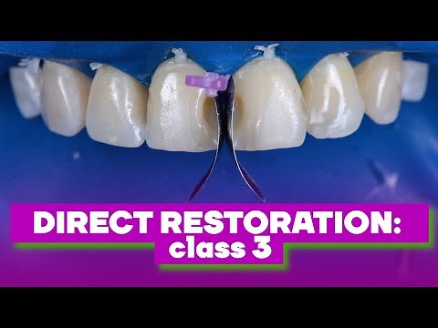 Direct restoration: class 3 | BG Dental Cases #31