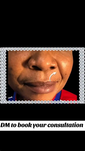 Natural Enhancements for Nasolabial Folds