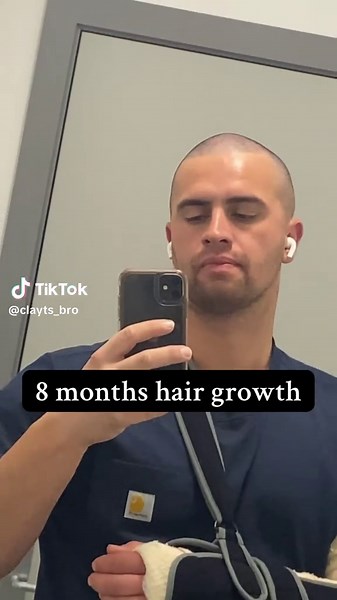 Men's Hair Growth Journey: 8 Months Time-lapse