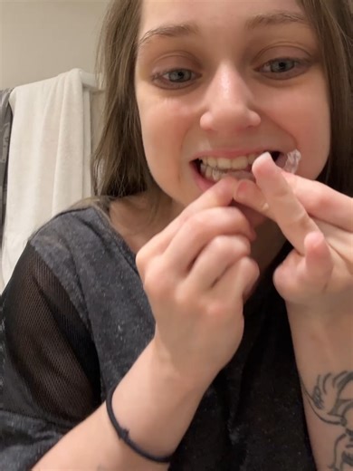 Well it is another passive tray change, no big deal except the tech accidentally cut the upper trays instead of the lower trays. It's a good thing their passive and we actually prepared for this just in case. The girl is honestly the sweetest person and we were both glad that it was a passive week. If there was any time for a mistake that was the perfect time. We are on Passive Trays-meaning they are copies of the last tray that was providing movement so they can settle as is and then Invisalign