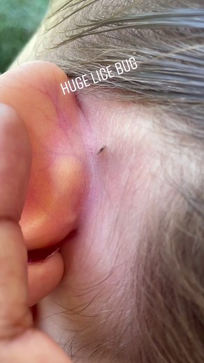 Understanding Lice: What You Need to Know