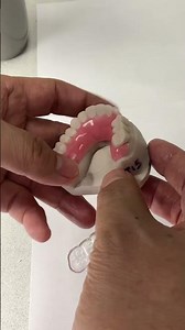 Acrygrip flipper with Essix Appliance!