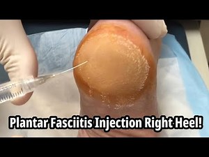 Plantar Fasciitis Injection Right Heel, Jenny Assists!