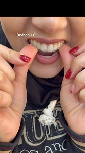 170 reactions · 8 comments | ✨ Aligneurs vs. Brackets : Quel est le...