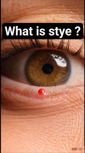 Stye in Eye 👁️ What Causes It?#stye #eyeinfection #eyehealth #healthfacts #humanbody #viral #ytshort