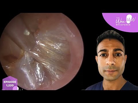 1,220 - Trapped Ear Wax & Dead Skin Removal from Itchy Ear