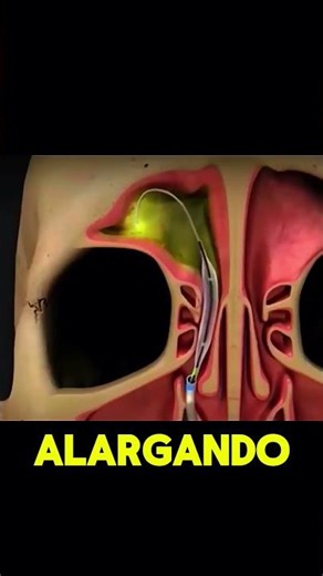 O FIM DA SINUSITE? Como funciona a cirurgia sem cortes 👃 #shorts #sinusite #curiosidades
