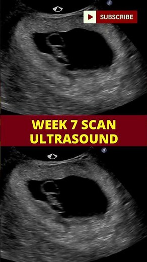 ultrasound scan week 7 | pregnancy scan | week by week pregnancy