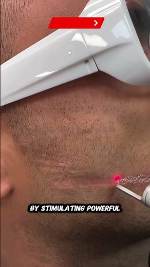 Fractional CO2 Laser Scar Removal | Deep Skin Renewal
