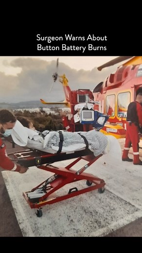 197 reactions · 50 shares | Dr Kim Aikins shares how the acid from button batteries can burn a hole through the oesphogus causing severe harm to tamariki if swallowed. These burns mean that some children will struggle to eat and drink and may need regular surgeries and different ways of feeding for many years. If you need to have button batteries in your home, make sure these are stored out of reach and sight of children in locked containers. | Safekids Aotearoa | Facebook