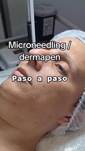 Microneedling Dermapen for Facial Remodeling | Step by Step Guide