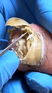 Pedicure for Long Toenails with Fungus Build-Up Treatment E940 #OddlySatisfying #ingrowntoenail #toenailremoval #ingrownnail #NailTransformation Disclaimer: This video is for educational and relaxation purposes only. All content belongs to the respective owners, no copyright infringement is intended. | Toenail 23