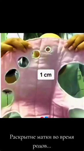 Understanding Uterine Rupture During Childbirth