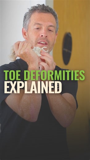THE FOOT COLLECTIVE on Instagram: "Are you worried about Toe Deformities? In this week’s video, podiatrist @andybryant_podiatrist breaks down toe deformities, including bunions, hammer toes, and claw toes, explaining what they are, why they develop, and what actually helps improve comfort and function. Rather than treating toe deformities as purely structural or genetic, Andy explores how footwear, loading, muscle function, and movement habits influence toe alignment over time. Comment ‘TOE HEAL