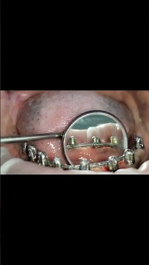 No gap between welded titanium wire and gum-effect of good alveoloplasty removing poor alveolar bone