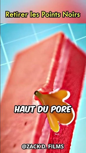 Comment fonctionne l'extraction des points noirs