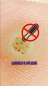 ¿Es un CALLO o una VERRUGA Plantar? 🦶 Haz esta PRUEBA