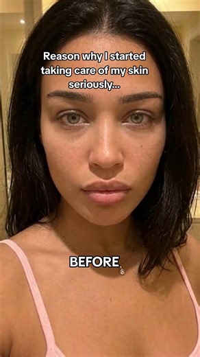 How she got rid of her undereyes #skincare #glowee #beauty