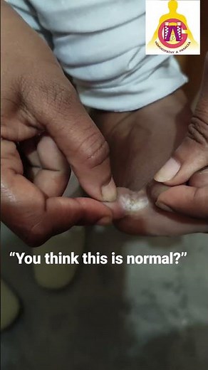 Between Toes Fungus for Years? | Chronic Athlete’s Foot Explained | Fungal Freedom