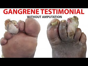 #GangreneToe testimonial - Diabetes Foot treatment without amputation