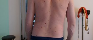 What's the difference between a scoliosis and a lateral shift?