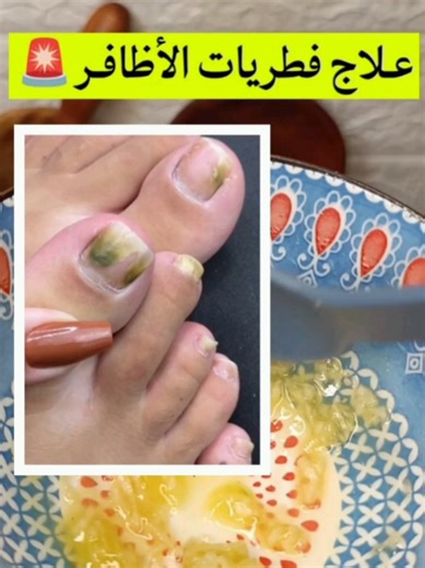 علاج فطريات الأظافر بطرق طبيعية فعالة