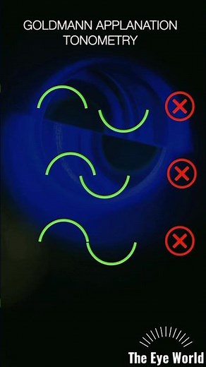 goldmann applnation tonometry