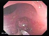 Endoscopic Appearance of Pedicled Polyp of the Descending Colon (6 of 7) • Video • MEDtube.net