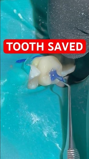 This Tooth Was Almost Lost… Final EMAX Overlay Restoration