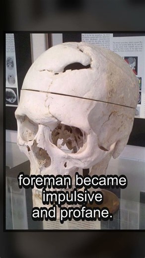 An Iron Bar Went Through His Skull—and He Survived #Shorts