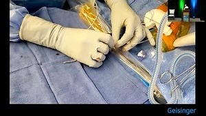 His Bundle Pacing: A Case Presentation