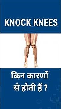 What causes knock knees?