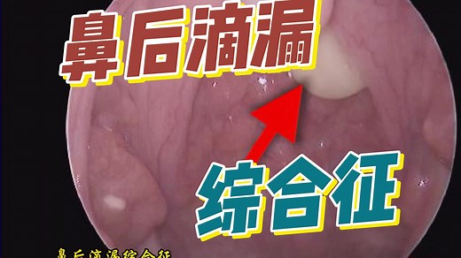 【体征】鼻后滴漏综合征