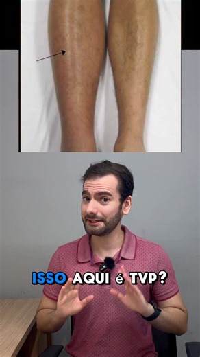 Ebenézer Bandeira on Instagram: "E aí: você também aprendeu a fazer o teste de Homans como se fosse uma feitiçaria dos antigos magos médicos? Pois se liga: não adianta de nada! Se você quer aprender as principais abordagens clínicas na atenção primária, se liga no nosso curso on-line APS 101! Link na bio"